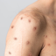 An example of monkeypox rashes.